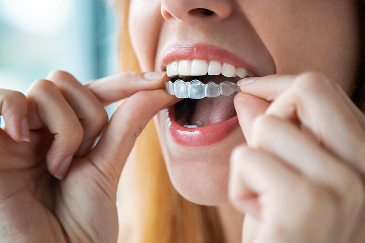 lindsay giguiere, smiles for miles, retainer alignment and molds kit collection